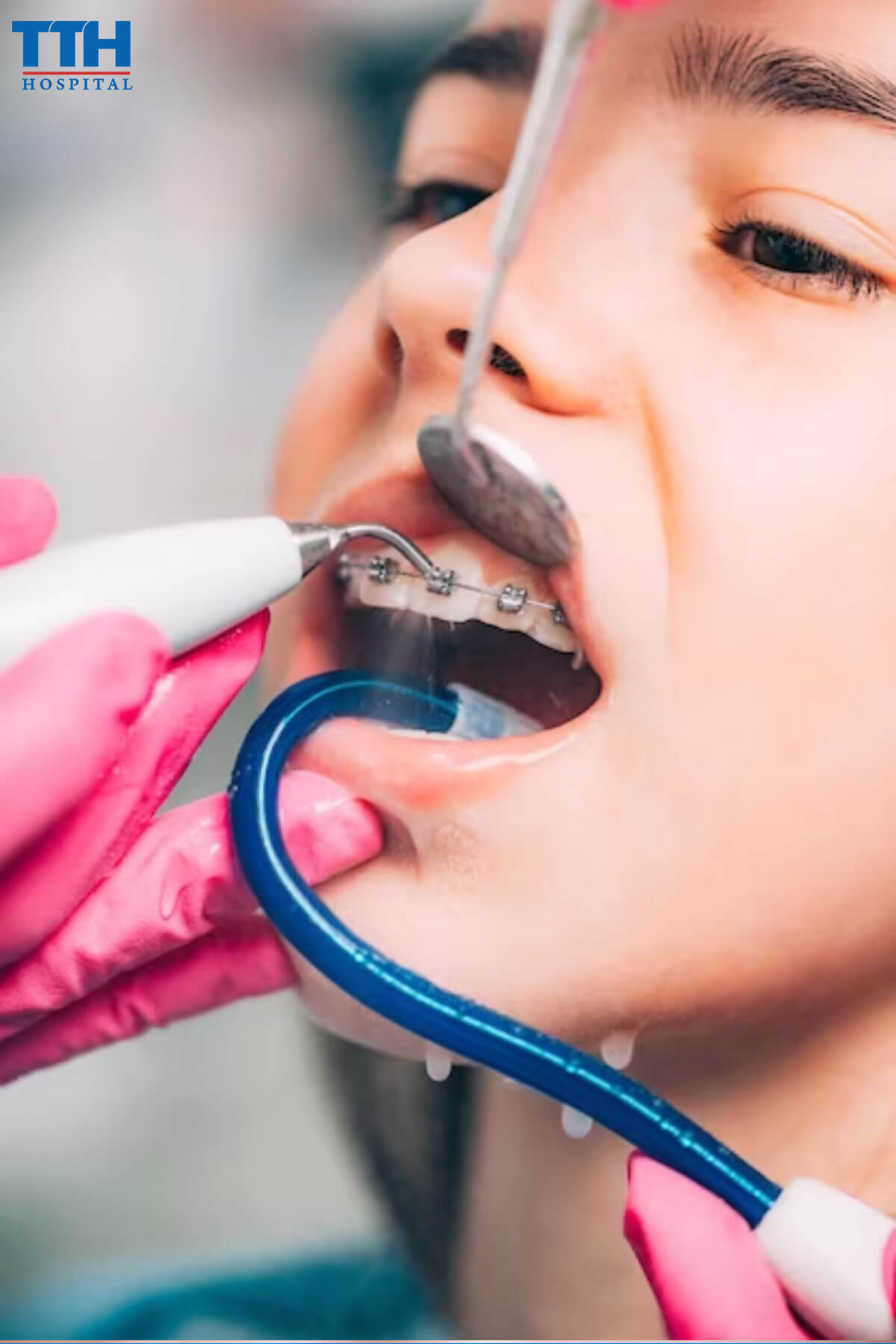 Quá trình niềng răng chuẩn bộ y tế tại vinh nghệ an