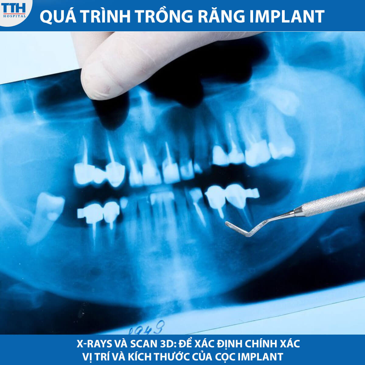 X-rays và scan 3D: Để xác định chính xác vị trí và kích thước của cọc implant