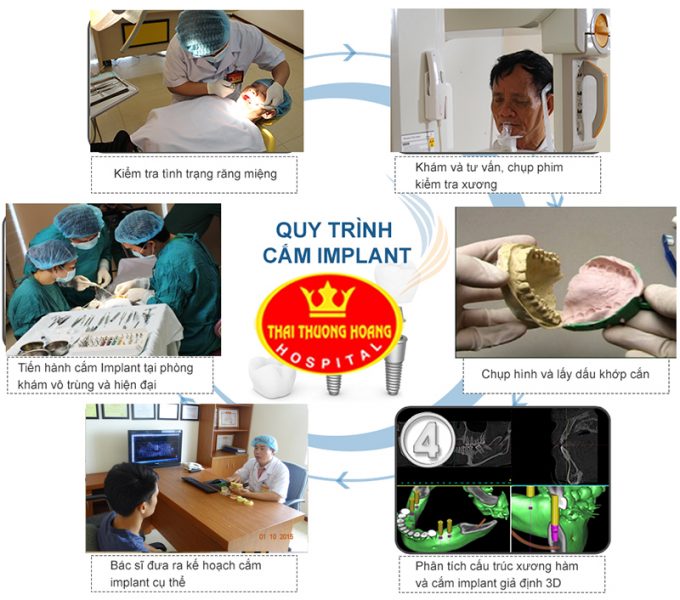 Những ai không thể cắm răng implant?
