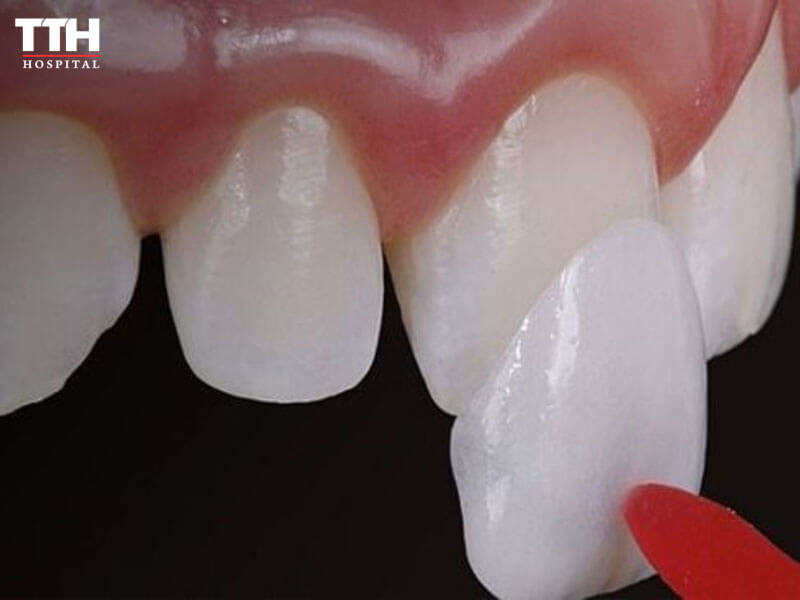 Quy trình dán sứ veneer