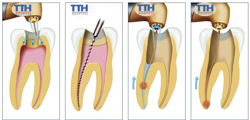 Lợi ích của việc điều trị viêm tuỷ răng sữa