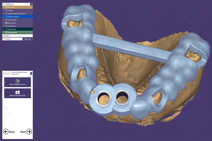 Quy trình tạo máng hướng dẫn phẫu thuật implant