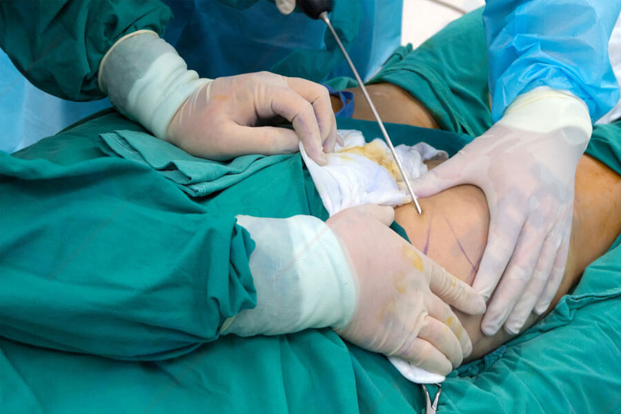 Quy trình thực hiện Body Jet