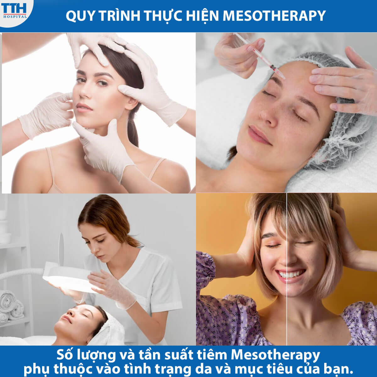 Quy trình thực hiện Mesotherapy