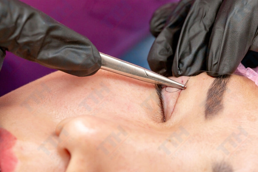 Quy Trình Thực Hiện Phẫu thuật mí trên Perfect Eyes TTH