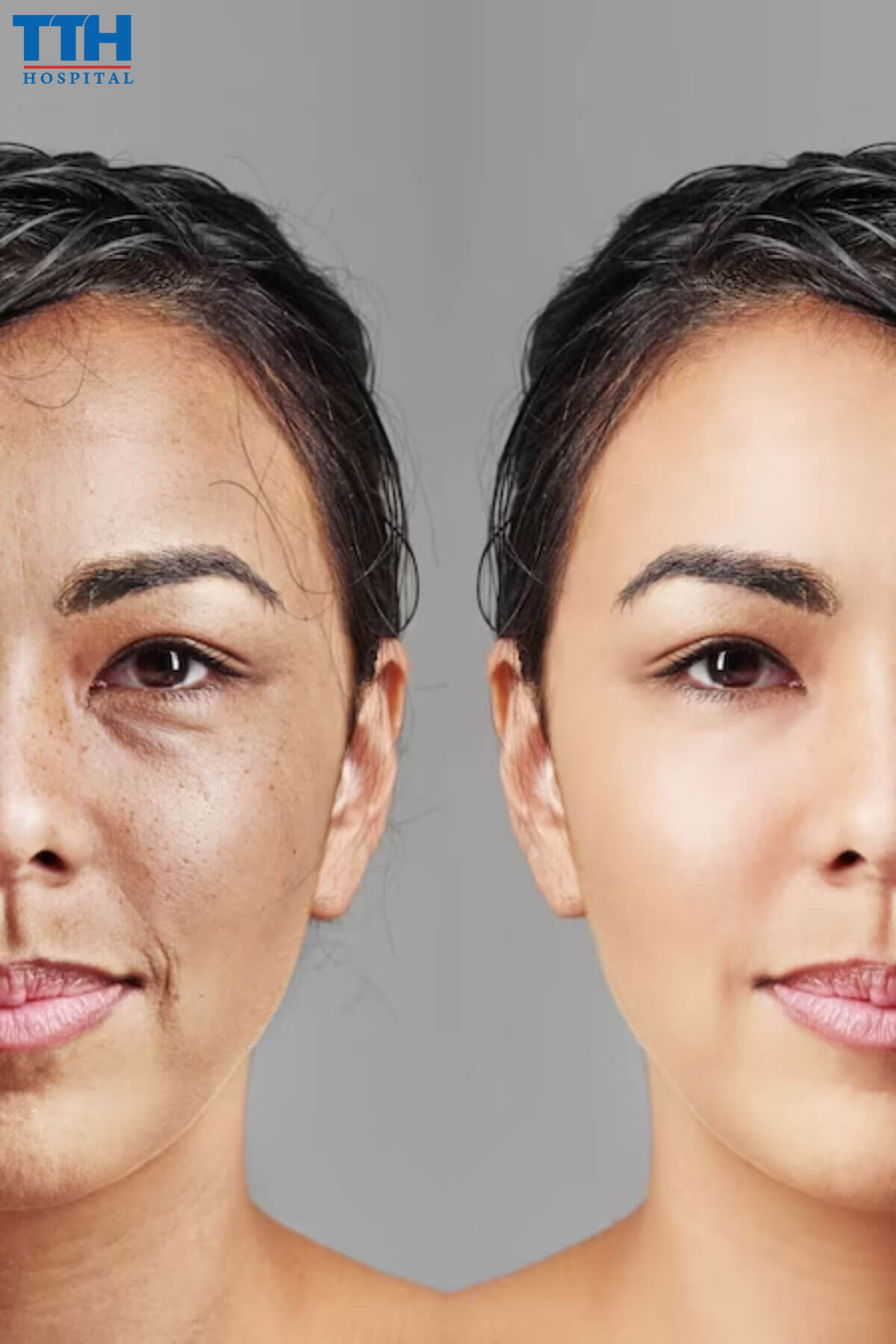 Quy Trình Trị Nám Bằng Laser trị nám tại Vinh, Nghệ An
