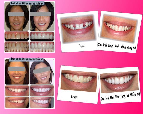Răng sứ thẩm mỹ tại bệnh viện thái thượng hoàng