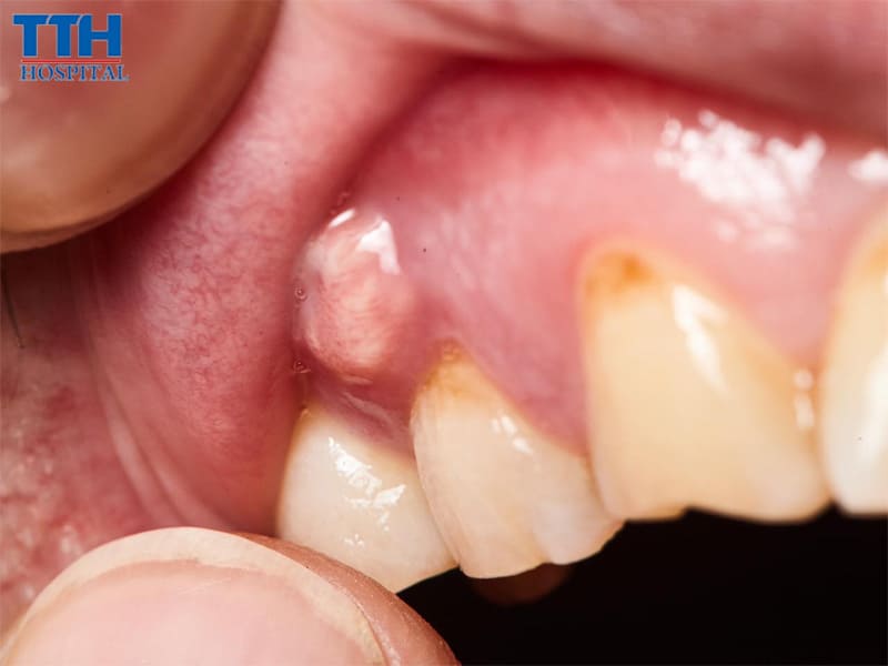 Răng bị nhiễm trùng hoặc viêm nhiễm nặng