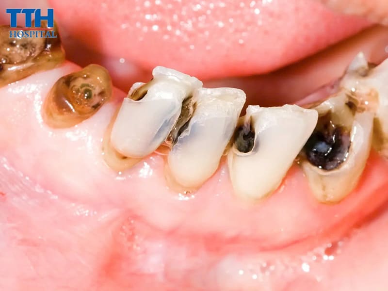 Răng bị sâu hoặc hư hỏng nghiêm trọng