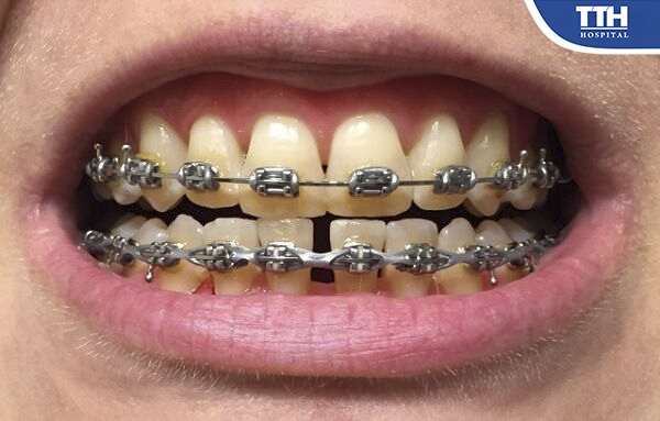 Nếu vệ sinh không sạch dẫn đến răng bị ố màu khi niềng