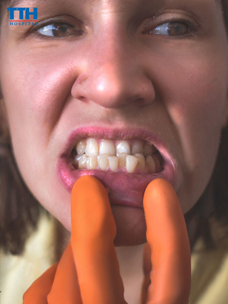 Răng dưới nhô lên (underbite)