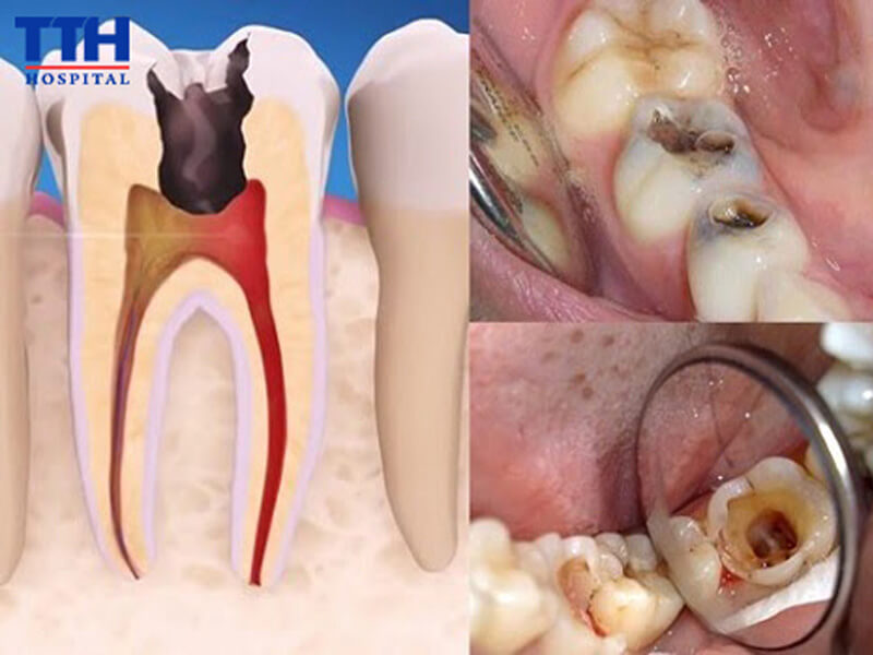 Răng sau điều trị tủy có đặc điểm gì?