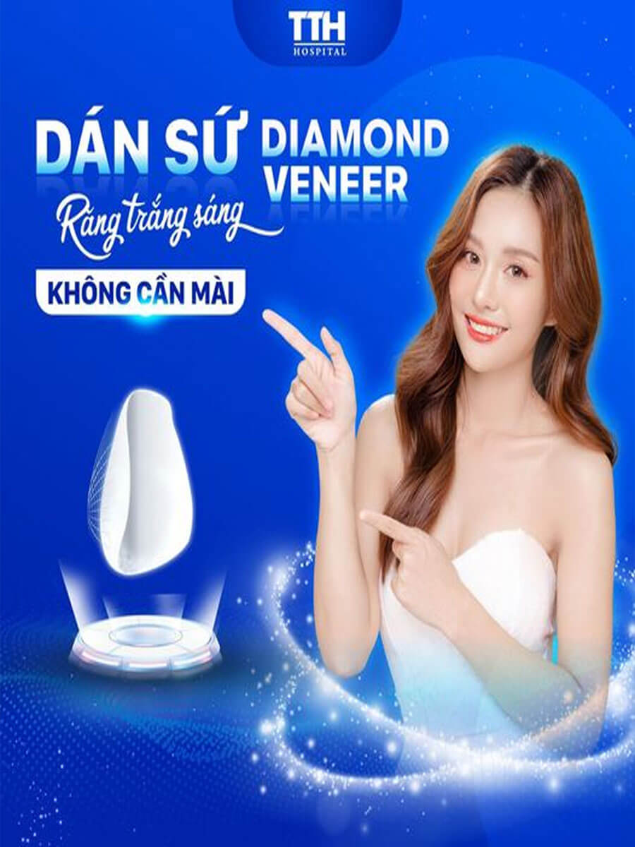 Răng sứ Diamond Veneer