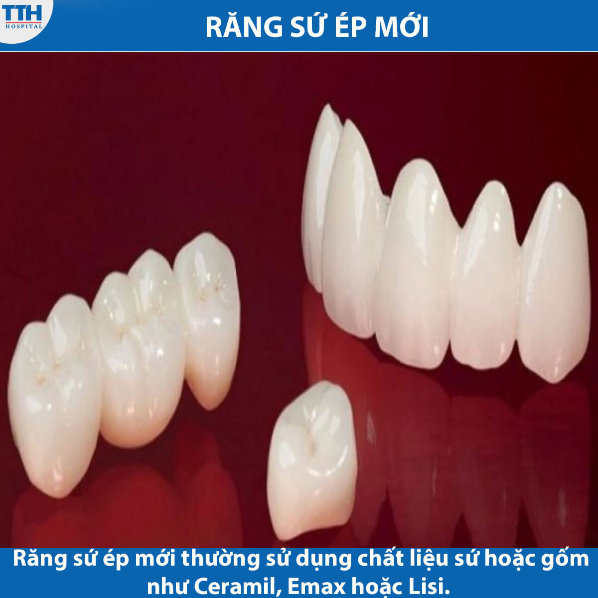 Răng Sứ Ép Mới