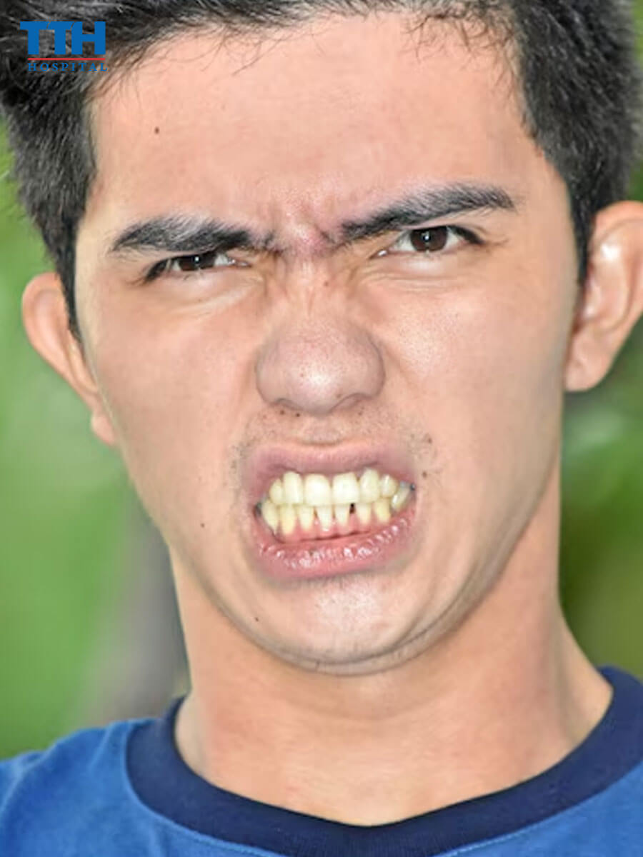 Răng trên và dưới không khớp (crossbite)