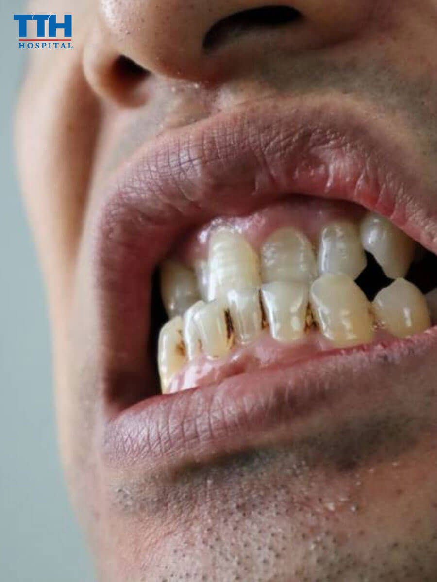 Răng trên và dưới không tiếp xúc (open bite)