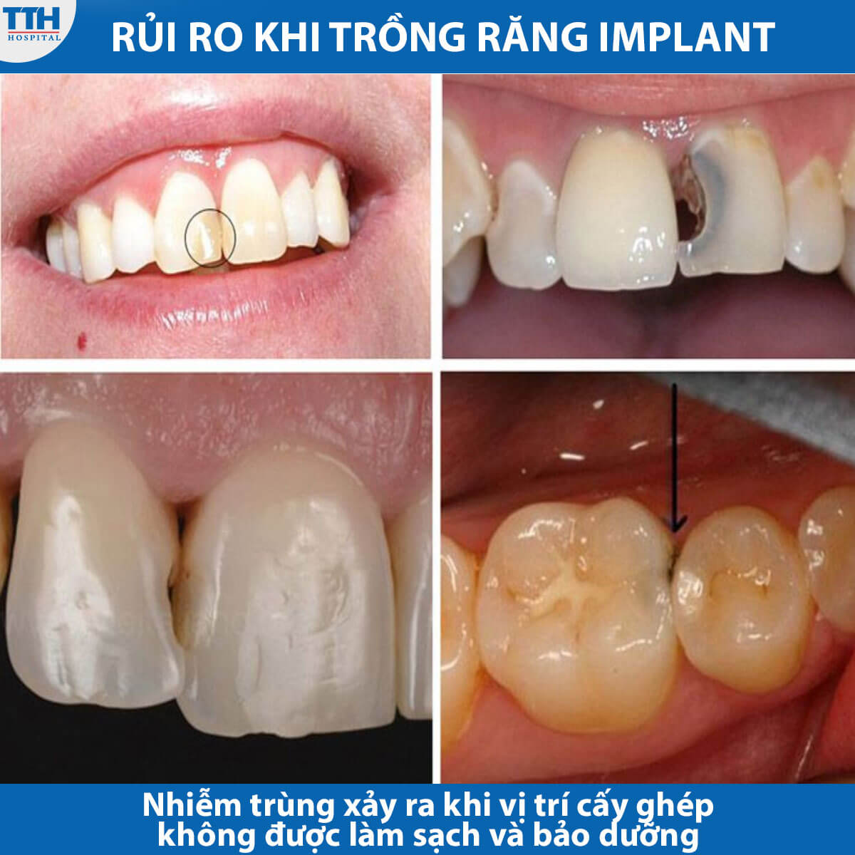 Rủi ro khi trồng răng implant