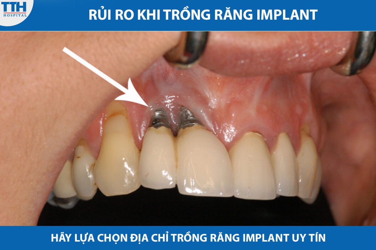 Rủi ro khi trồng răng Implant