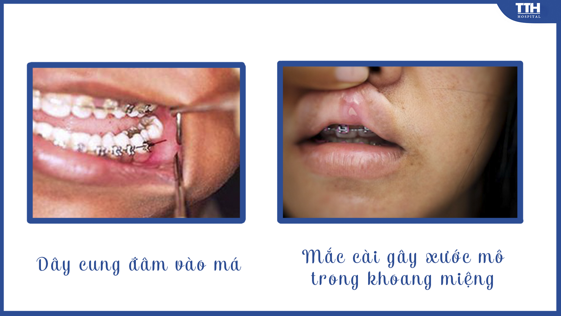 Dây cung đâm vào má và góc của mắc cài dễ gây tổn thương mô trong khoang miệng