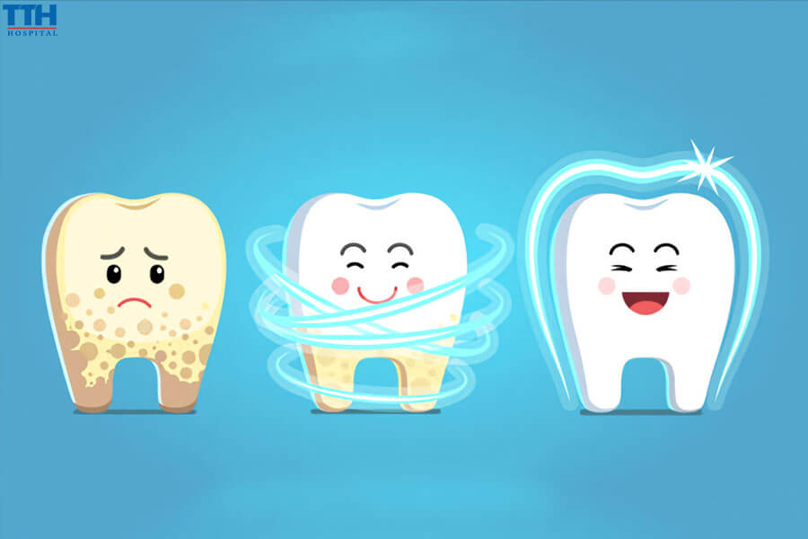 Tại Sao Cần Lấy Cao Răng Định Kỳ?