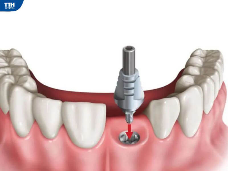 Tại sao nên trồng răng càng sớm càng tốt?