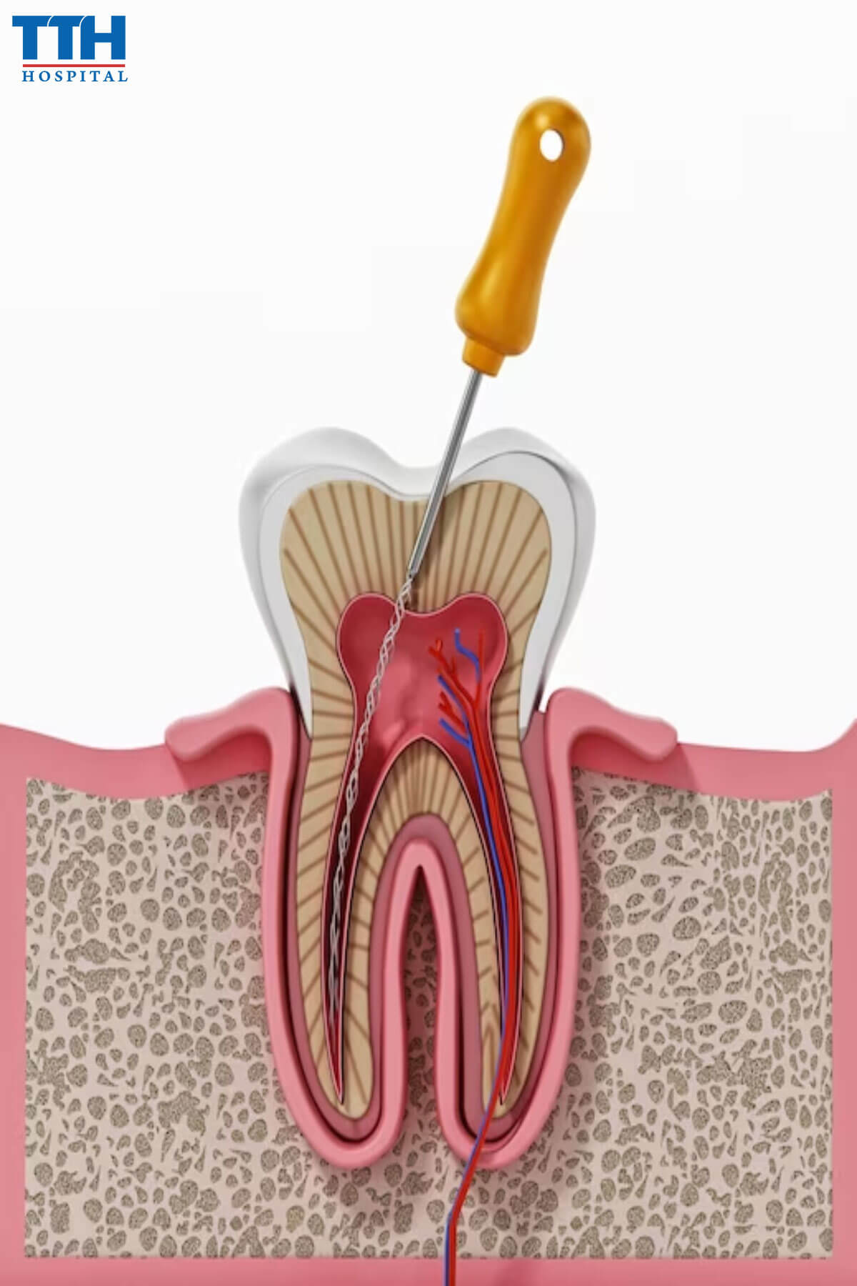 Tại sao cần điều trị tủy răng tại Vinh, Nghệ An?