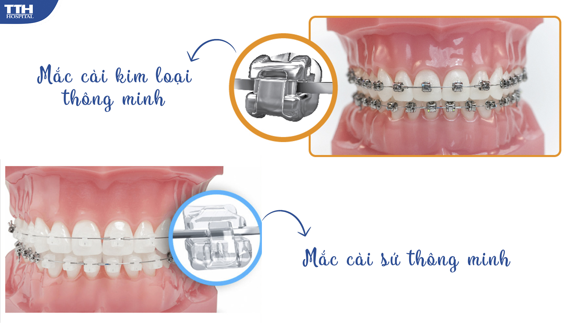 Mắc cài thông minh là gì?