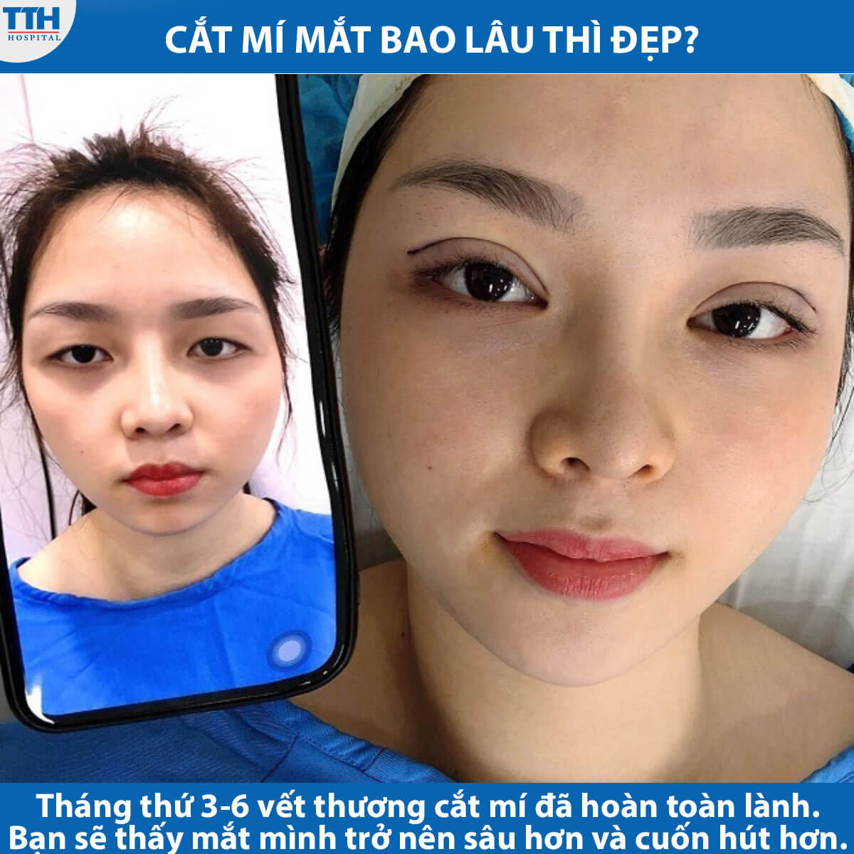 Thời gian hồi phục sau khi cắt mí mắt