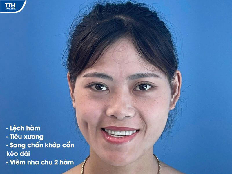 Thực hiện thành công ca phẫu thuật hàm mặt