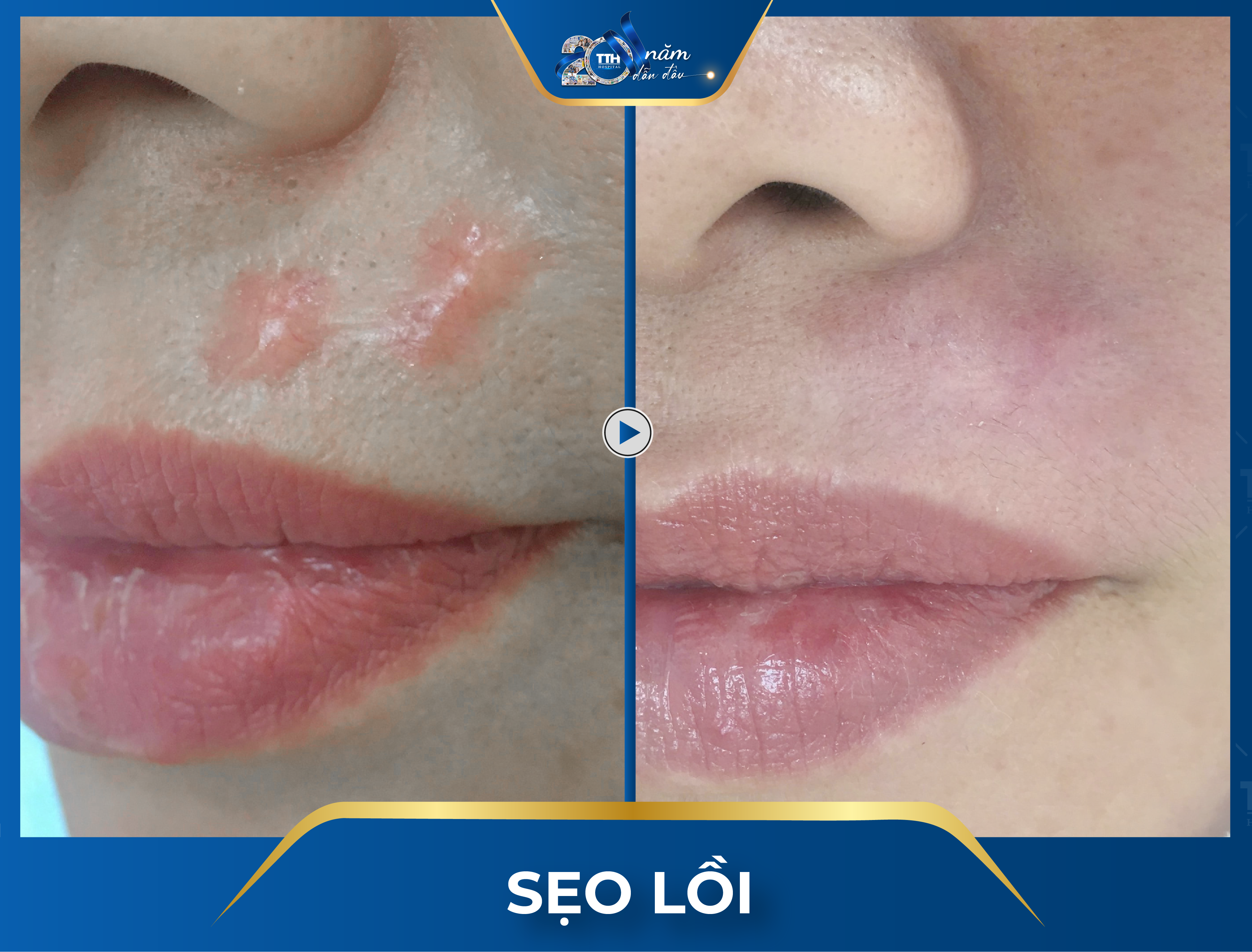 Công nghệ điều trị sẹo Laser Fractional tại bệnh viện Thái Thượng Hoàng