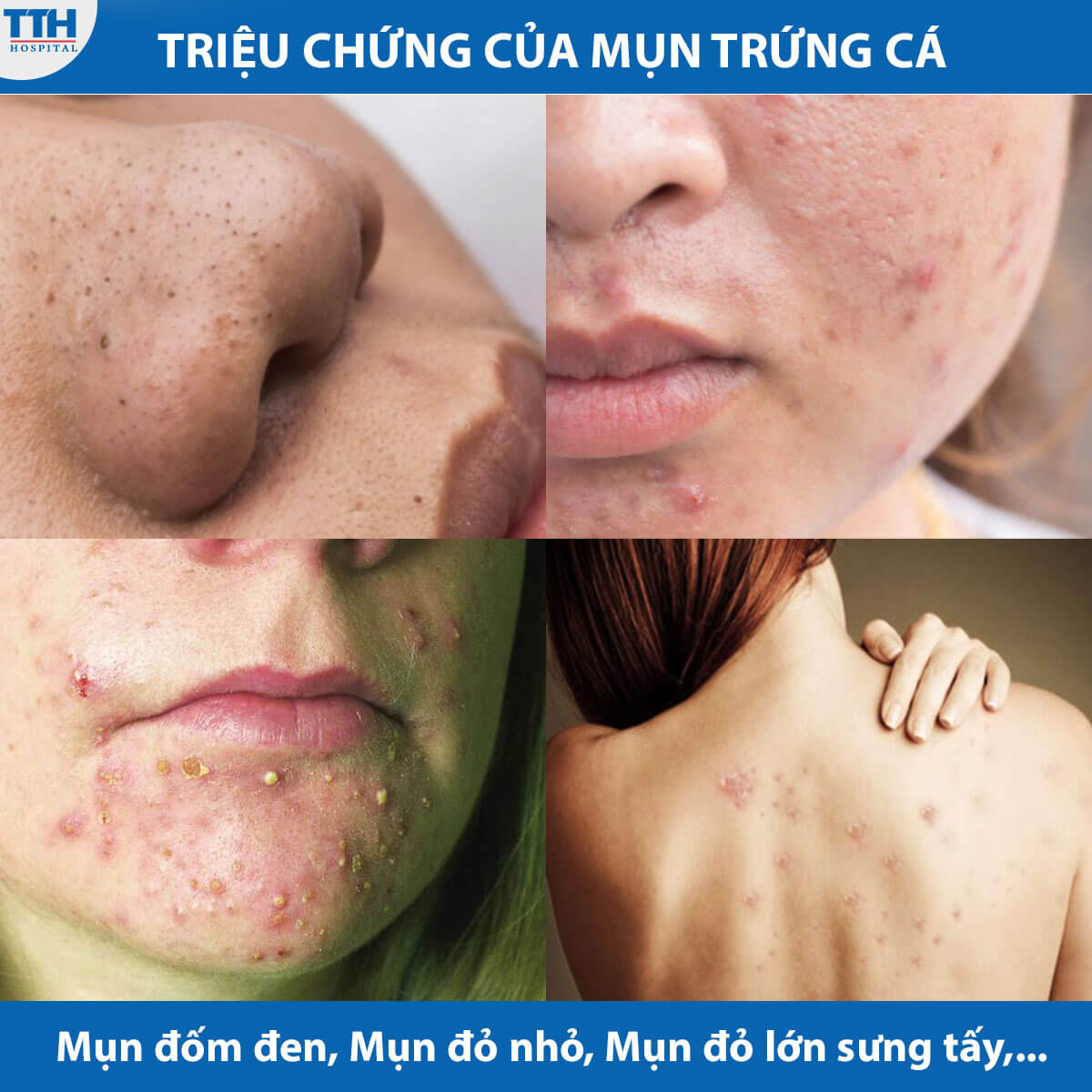 Triệu chứng của mụn trứng cá