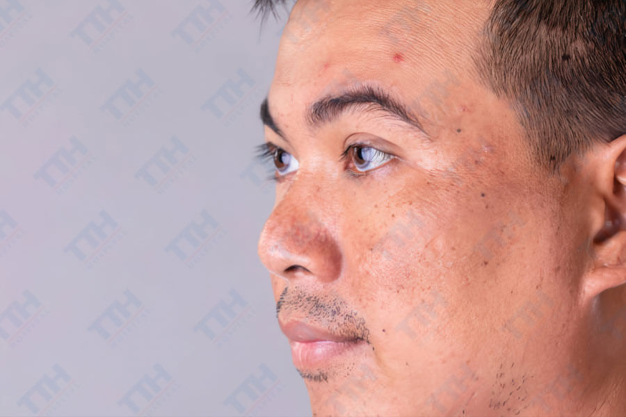 Triệu chứng của nám da ở nam giới