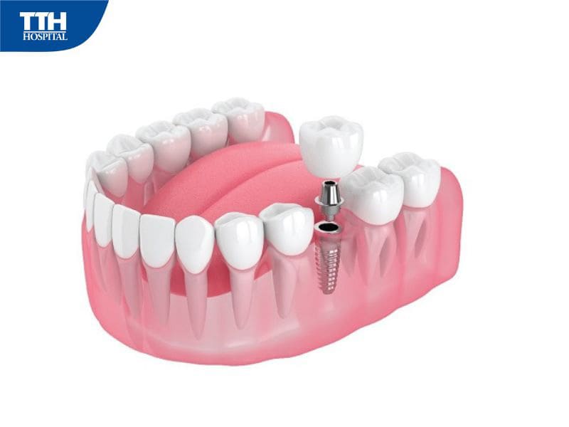 Trồng răng Implant có ưu điểm gì?
