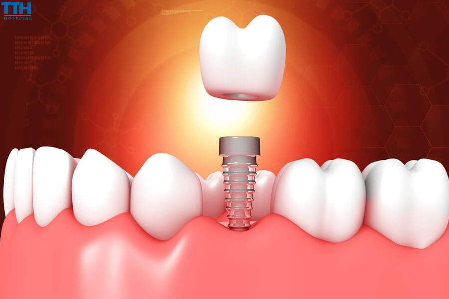 Trồng răng implant là gì?