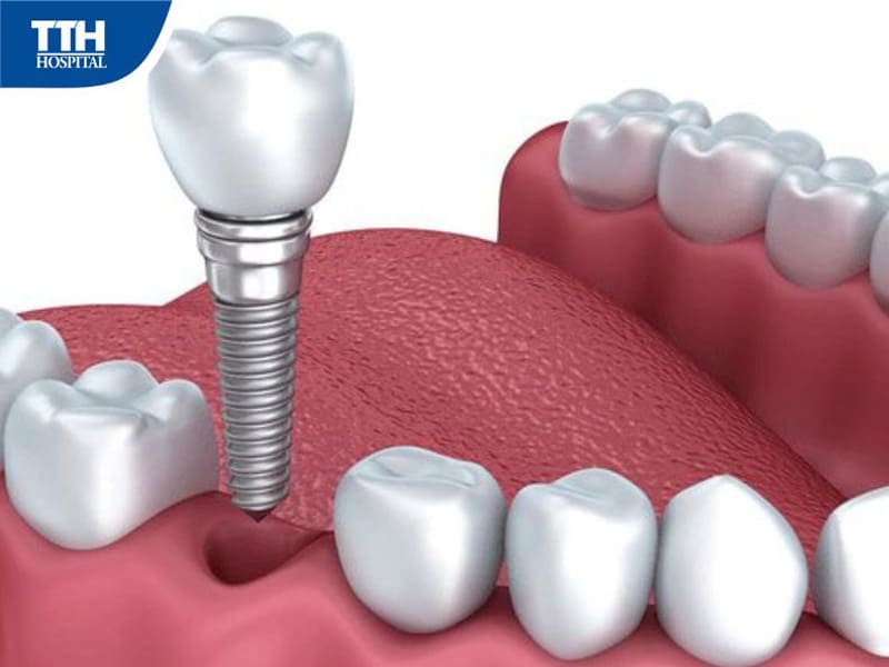 Trồng răng Implant là gì?