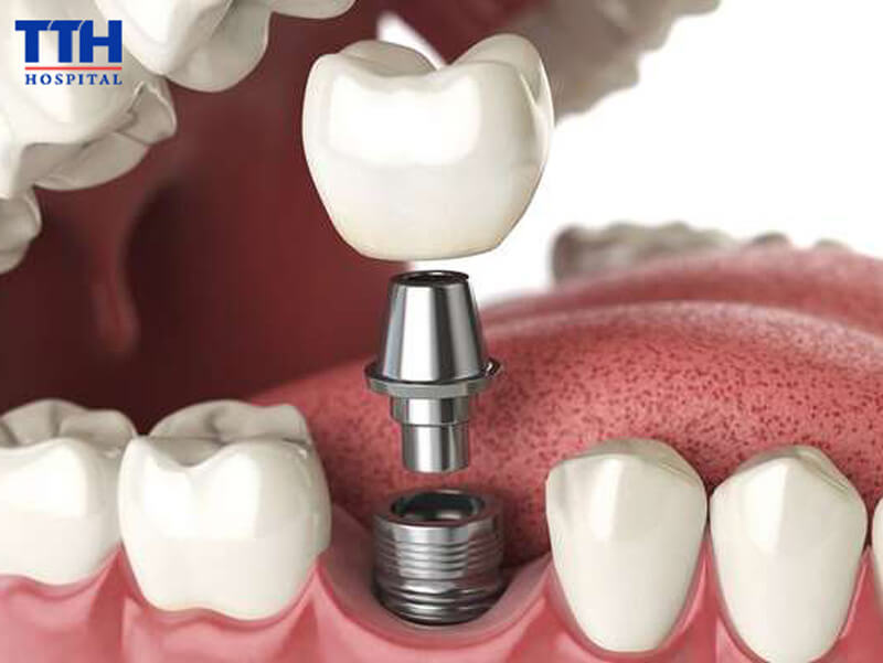 TRỒNG RĂNG IMPLANT LÀ GÌ? 