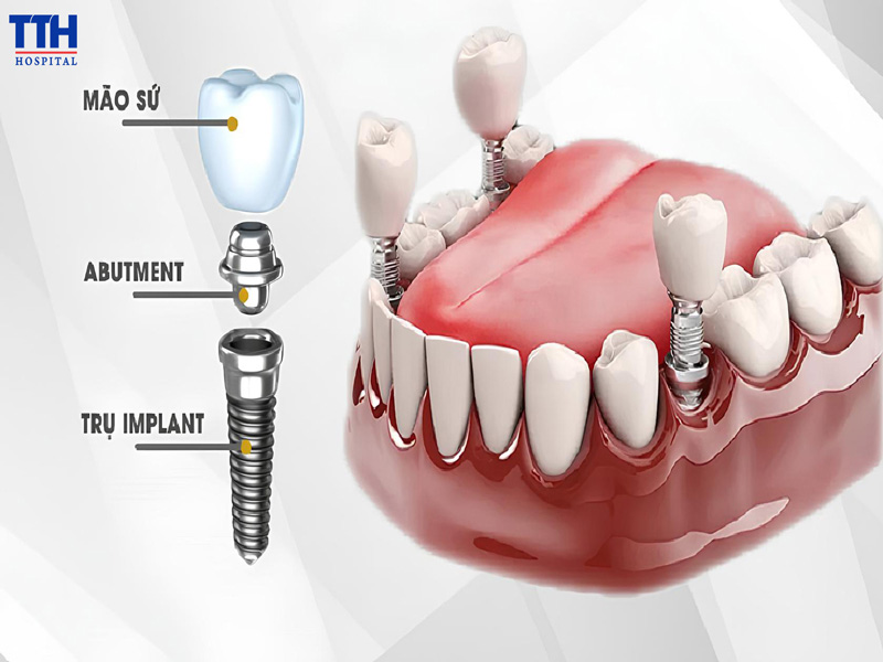 Quy trình cấy ghép Implant tức thì chuẩn y khoa