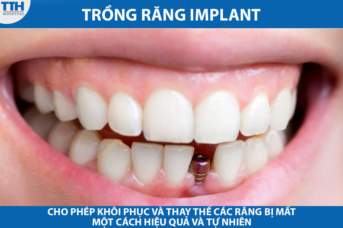 Trồng răng implant là một phương pháp thay thế răng bằng cách đặt một cọc nhỏ