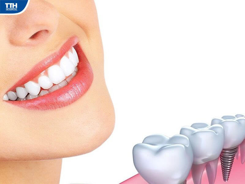 Trồng răng implant tại Bệnh viện Thái Thượng Hoàng