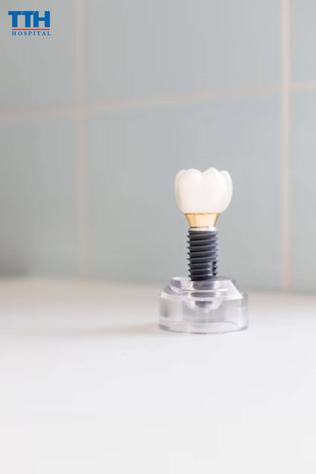 Trồng răng implant là gì?