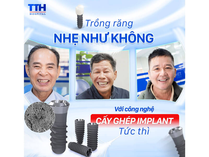 Trồng răng Implant Thái Thượng Hoàng – Giải pháp phục hồi răng mất an toàn và uy tín