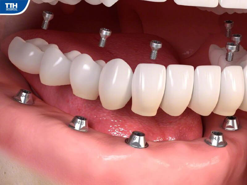 Trồng răng implant toàn hàm là gì?