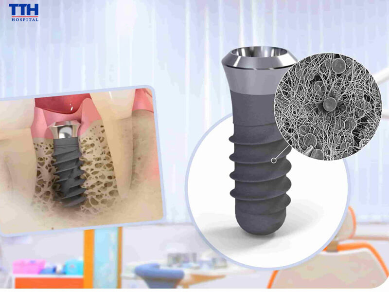 Trụ Implant Straumann – Sự lựa chọn của nhiều khách hàng tại Bệnh viện Thái Thượng Hoàng