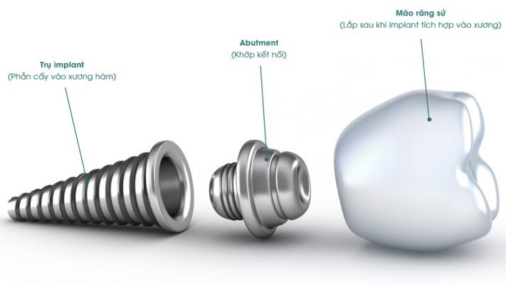 Cấu tạo của 1 chiếc răng implant