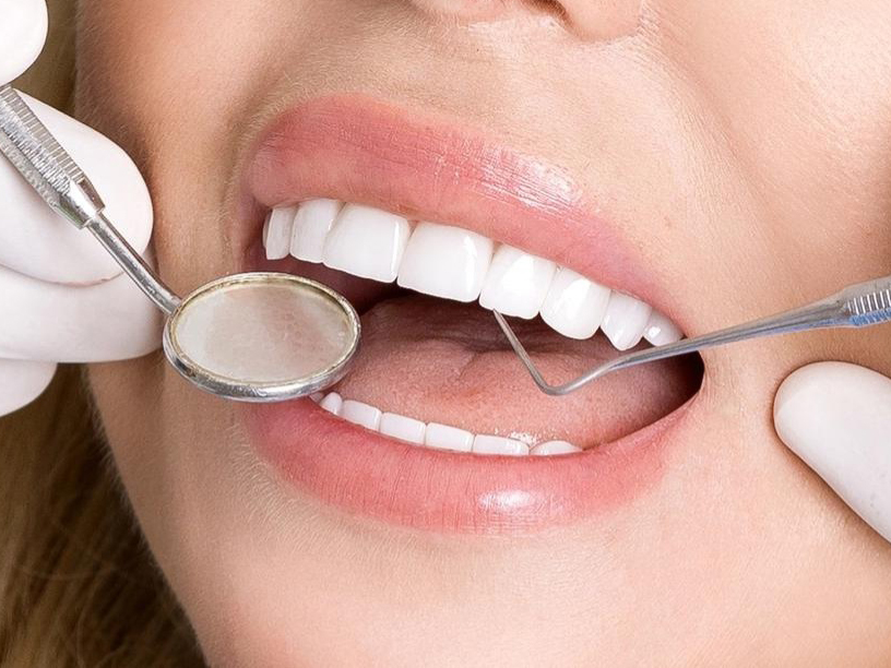 Cách chăm sóc và ngăn ngừa cao răng sau khi bọc răng sứ