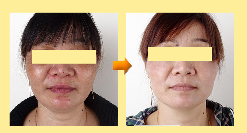 Giải đáp thắc mắc thường gặp về điều trị nám, tàn nhang