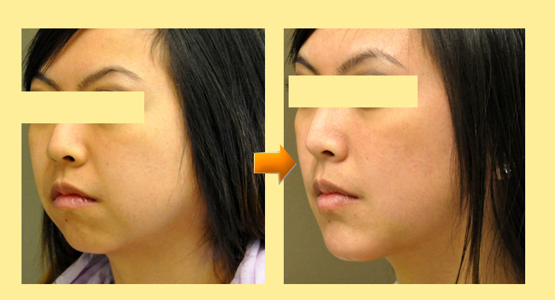 HÌNH ẢNH TRƯỚC VÀ SAU KHI ĐỘN CẰM LẸM  