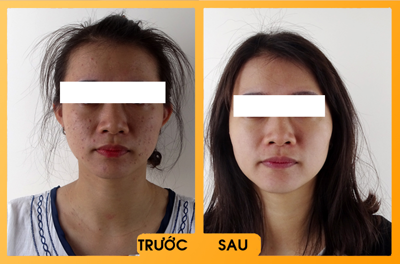 Hình ảnh khách hàng sau khi điều trị mụn tại bệnh viện thái thượng hoàng 3