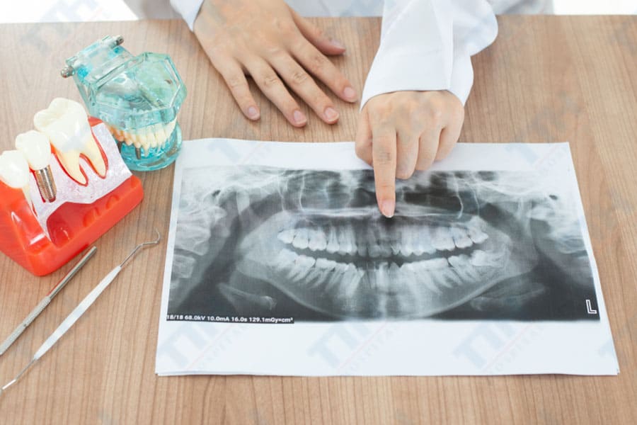 Trường Hợp Nào Có Thể Không Cần Nhổ Răng Khi Niềng?