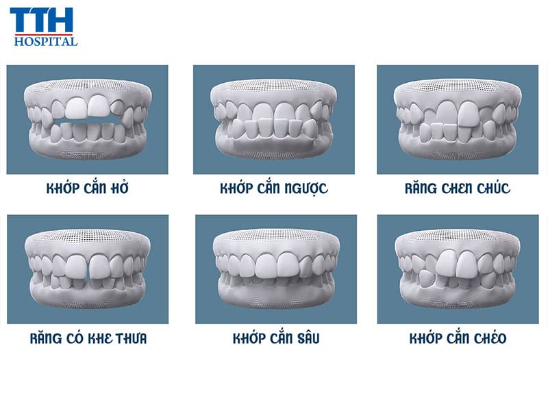 Những trường hợp nên niềng răng trong suốt